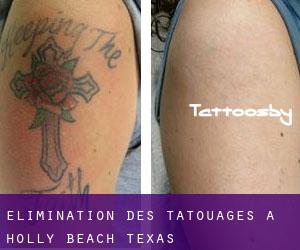 Élimination des tatouages à Holly Beach (Texas)