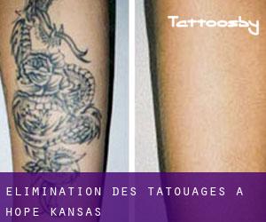 Élimination des tatouages à Hope (Kansas)