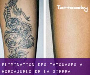 Élimination des tatouages à Horcajuelo de la Sierra
