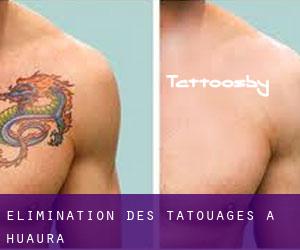 Élimination des tatouages à Huaura