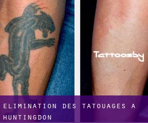 Élimination des tatouages à Huntingdon