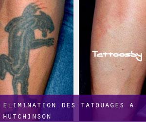 Élimination des tatouages à Hutchinson