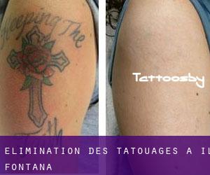 Élimination des tatouages à Il-Fontana