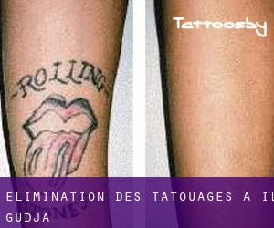 Élimination des tatouages à Il-Gudja