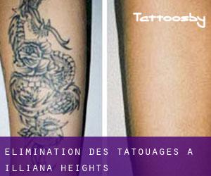 Élimination des tatouages à Illiana Heights