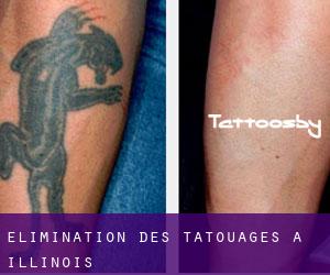 Élimination des tatouages à Illinois