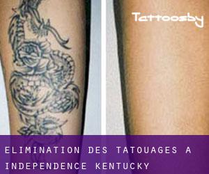 Élimination des tatouages à Independence (Kentucky)