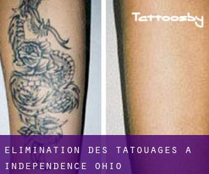 Élimination des tatouages à Independence (Ohio)