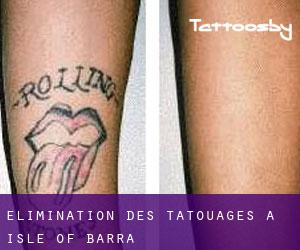 Élimination des tatouages à Isle of Barra