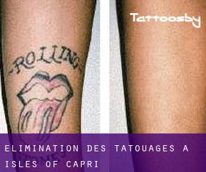 Élimination des tatouages à Isles of Capri
