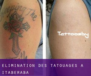 Élimination des tatouages à Itaberaba