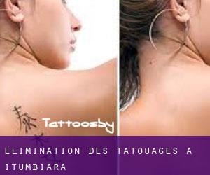 Élimination des tatouages à Itumbiara