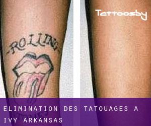 Élimination des tatouages à Ivy (Arkansas)