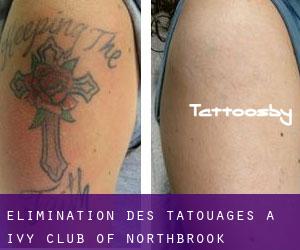 Élimination des tatouages à Ivy Club of Northbrook