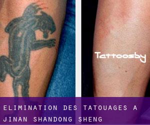 Élimination des tatouages à Jinan (Shandong Sheng)