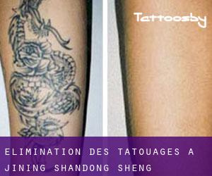 Élimination des tatouages à Jining (Shandong Sheng)