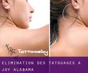 Élimination des tatouages à Joy (Alabama)