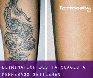 Élimination des tatouages à Kennebago Settlement