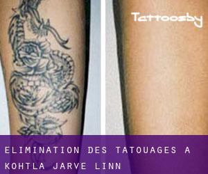 Élimination des tatouages à Kohtla-Järve linn