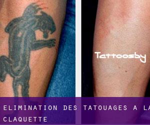 Élimination des tatouages à La Claquette