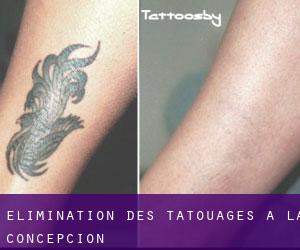 Élimination des tatouages à La Concepción