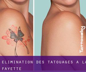 Élimination des tatouages à La Fayette