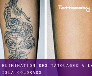 Élimination des tatouages à La Isla (Colorado)