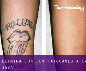 Élimination des tatouages à La Joya
