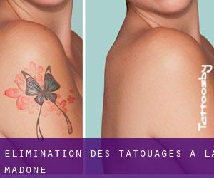 Élimination des tatouages à La Madone