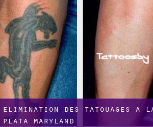Élimination des tatouages à La Plata (Maryland)