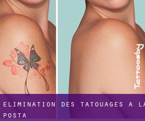 Élimination des tatouages à La Posta
