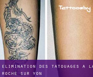 Élimination des tatouages à La Roche-sur-Yon