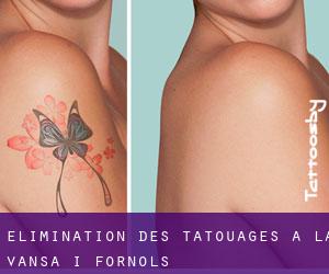 Élimination des tatouages à la Vansa i Fórnols