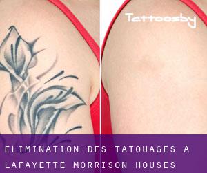 Élimination des tatouages à Lafayette Morrison Houses