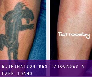 Élimination des tatouages à Lake (Idaho)
