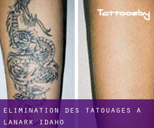 Élimination des tatouages à Lanark (Idaho)