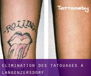 Élimination des tatouages à Langenzersdorf