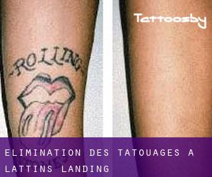 Élimination des tatouages à Lattins Landing