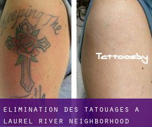 Élimination des tatouages à Laurel River Neighborhood