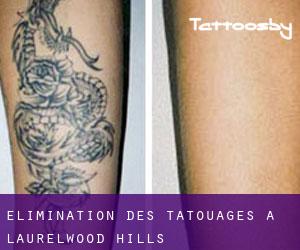 Élimination des tatouages à Laurelwood Hills