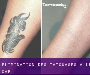 Élimination des tatouages à Le Cap