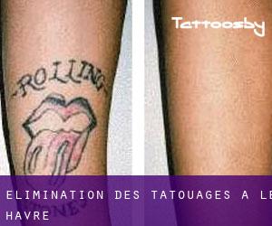Élimination des tatouages à Le Havre
