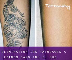 Élimination des tatouages à Lebanon (Caroline du Sud)