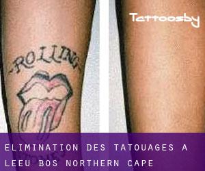 Élimination des tatouages à Leeu Bos (Northern Cape)