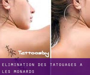 Élimination des tatouages à Les Monards