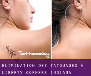 Élimination des tatouages à Liberty Corners (Indiana)