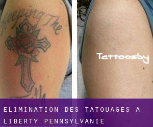 Élimination des tatouages à Liberty (Pennsylvanie)