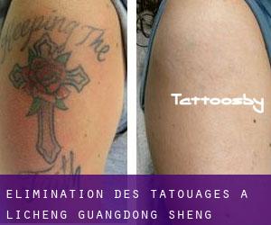 Élimination des tatouages à Licheng (Guangdong Sheng)