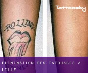 Élimination des tatouages à Lille