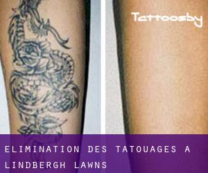 Élimination des tatouages à Lindbergh Lawns
